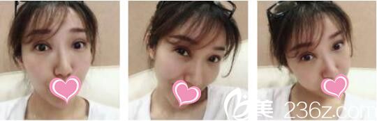 雙眼皮整失敗了怎么辦？看我找韓國(guó)天鵝swan整形黃成浩做了眼修復(fù)術(shù)后效果圖