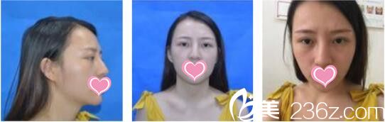 韓國天鵝swan整形醫(yī)院黃成浩鼻綜合+自體脂肪面部填充真人案例術(shù)前照 韓國天鵝swan整形醫(yī)院黃成浩鼻綜合+自體脂肪面部填充真人案例術(shù)前照