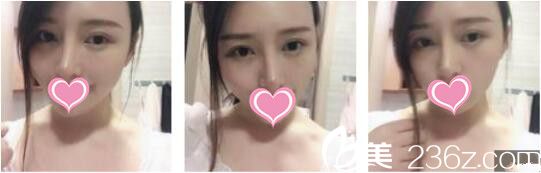 韓國天鵝swan整形醫(yī)院黃成浩鼻綜合+自體脂肪面部填充真人案例術(shù)后二十一天 韓國天鵝swan整形醫(yī)院黃成浩鼻綜合+自體脂肪面部填充真人案例術(shù)后二十一天