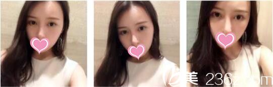 我在韓國(guó)天鵝swan整形找黃成浩做鼻綜合+自體脂肪面部填充，一個(gè)月的時(shí)間變身精致女神