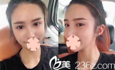 昆明夢想整形李成龍面部脂肪填充15天照 昆明夢想整形李成龍面部脂肪填充15天照