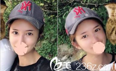 昆明夢想自體脂肪面部填充一個月照 昆明夢想自體脂肪面部填充一個月照