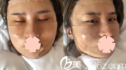 昆明夢想整形面部脂肪填充當天照 昆明夢想整形面部脂肪填充當天照