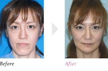 下巴形成術(shù)