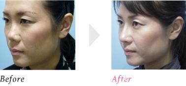 鼻中隔延長(zhǎng)