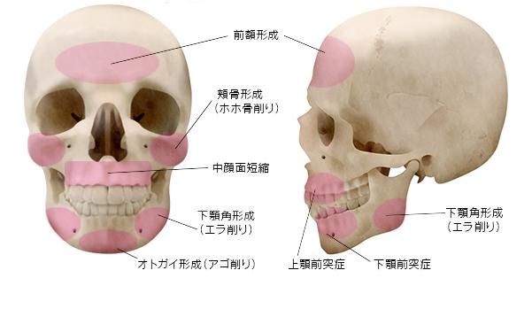 面部輪廓形成