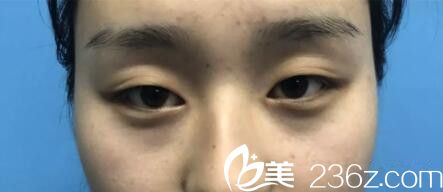 做元生態(tài)雙眼皮+開眼角術(shù)前照 做元生態(tài)雙眼皮+開眼角術(shù)前照