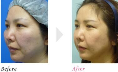 頰骨削除 頰骨削除