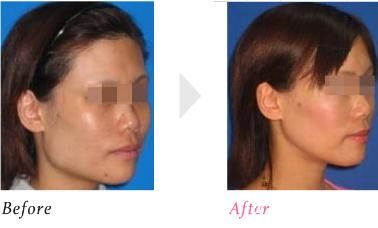 下顎角形成 下顎角形成