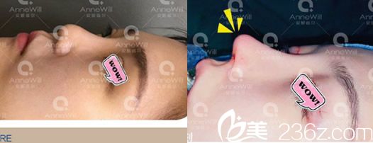 合肥安妮薇爾李繼銀肋軟骨鼻綜合案例 合肥安妮薇爾李繼銀肋軟骨鼻綜合案例