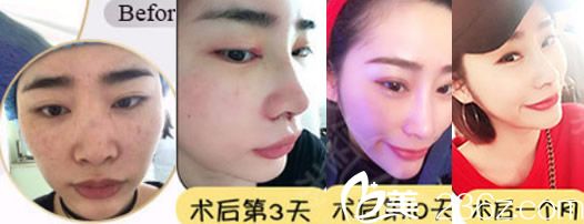 田軍達拉斯隆鼻術后恢復過程圖 田軍達拉斯隆鼻術后恢復過程圖