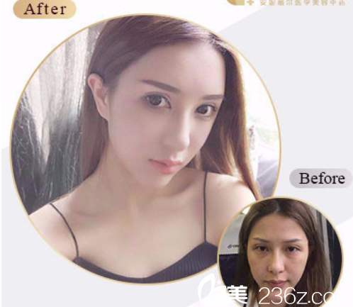 程林軍自體脂肪全臉填充案例 程林軍自體脂肪全臉填充案例