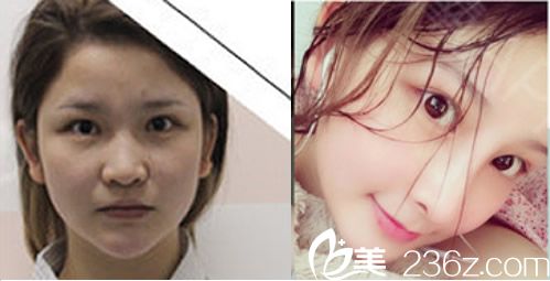 李秋艷玻尿酸除皺填充面部年輕化案例前后效果對比 李秋艷玻尿酸除皺填充面部年輕化案例前后效果對比