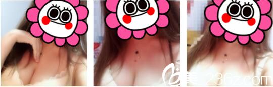 韓國天鵝swan整形醫(yī)院黃成浩自體脂肪隆胸真人案例術(shù)后十八天 韓國天鵝swan整形醫(yī)院黃成浩自體脂肪隆胸真人案例術(shù)后十八天