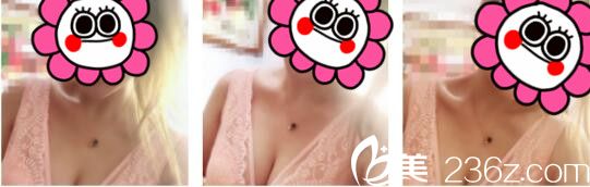 韓國天鵝swan整形醫(yī)院黃成浩自體脂肪隆胸真人案例術(shù)后一個月 韓國天鵝swan整形醫(yī)院黃成浩自體脂肪隆胸真人案例術(shù)后一個月