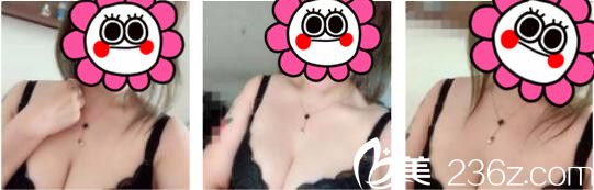 我只是去韓國(guó)天鵝swan整形找黃成浩做了自體脂肪隆胸，沒(méi)想到脂肪留存的很好手感也特別柔軟