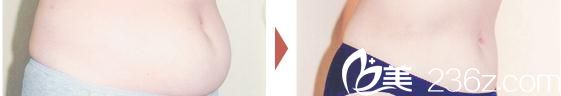 腹部吸脂