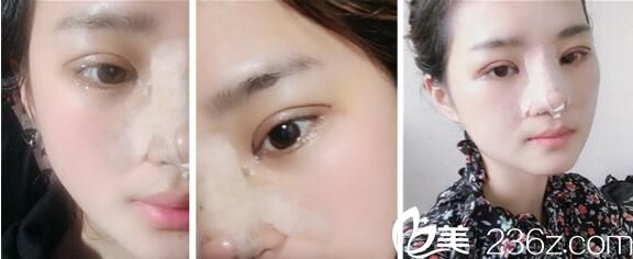 術(shù)后腫脹明顯