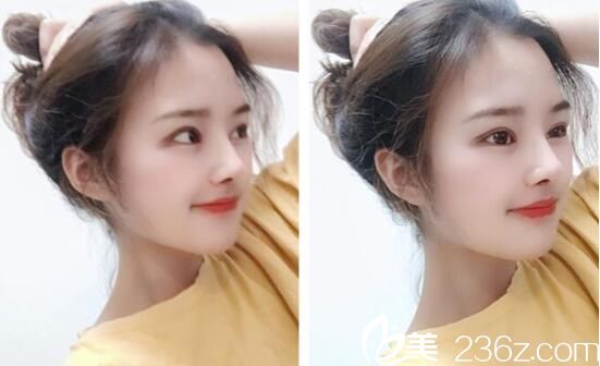 崔宰源眼鼻整形術(shù)后15天