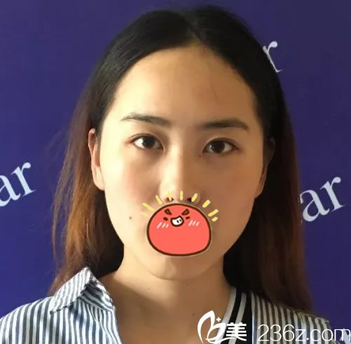 在嘉興藝星做雙眼皮手術(shù)前