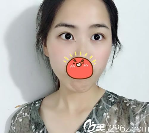 嘉興藝星雙眼皮案例7天恢復(fù)效果