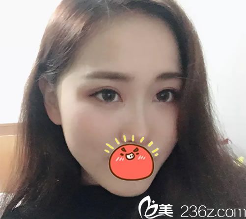 嘉興藝星美杜莎眼綜合案例