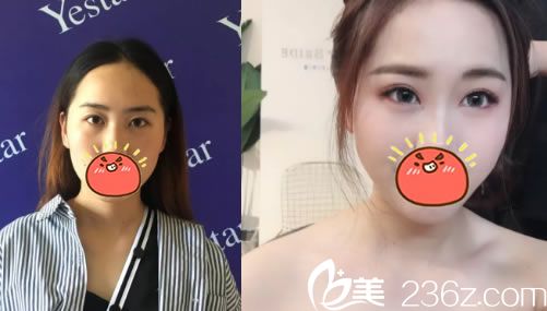 嘉興藝星割雙眼皮案例對(duì)比圖