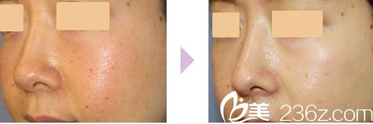 鼻中隔延長(zhǎng)術(shù)