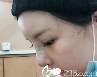 <!--<i data=20240703-sp></i>-->隆鼻整形怎么樣？陳茂年鼻綜合整形術(shù)后<span style=