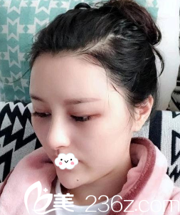 <!--<i data=20240703-sp></i>-->陳茂年硅膠假體隆鼻綜合整形術(shù)后<span style=