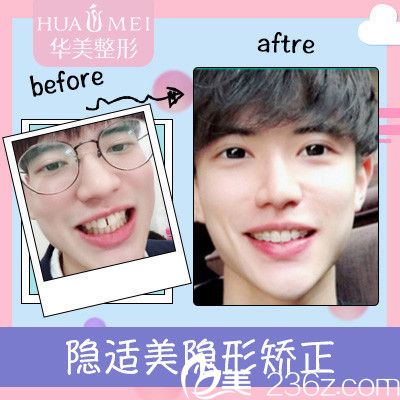 汕頭華美王宏偉隱適美牙齒矯正案例