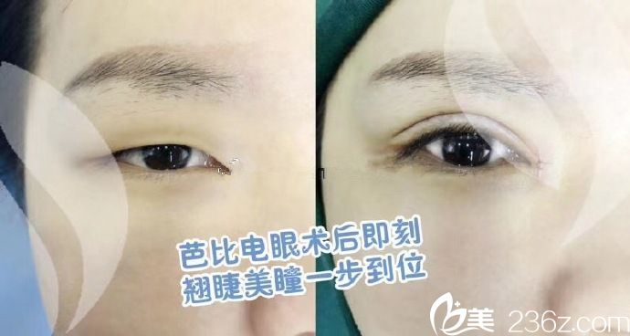 楊群申雙眼皮案例