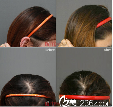 韓國ITEM（愛婷）整形醫(yī)院后腦勺整形案例