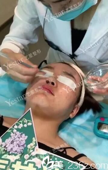 果酸換膚祛痘治療中