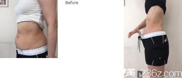 EXILIS機(jī)器進(jìn)行脂肪吸引