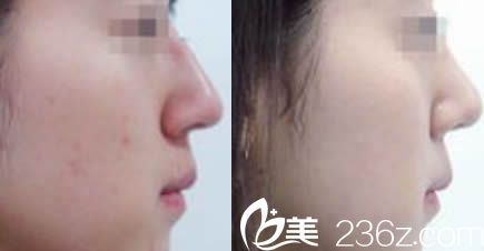 楚雄吳氏嘉美鼻綜合整形案例前后對比圖 楚雄吳氏嘉美鼻綜合整形案例前后對比圖