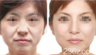 楚雄吳氏嘉美整形美膚除皺案例效果對比圖 楚雄吳氏嘉美整形美膚除皺案例效果對比圖