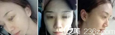 在長春中妍做自體肋軟骨隆鼻+自體脂肪填充額頭術(shù)前 在長春中妍做自體肋軟骨隆鼻+自體脂肪填充額頭術(shù)前