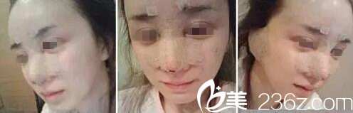 在長春中妍做自體肋軟骨隆鼻+自體脂肪填充額頭第1天 在長春中妍做自體肋軟骨隆鼻+自體脂肪填充額頭第1天