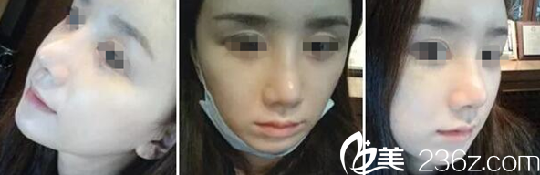 在長春中妍做自體肋軟骨隆鼻+自體脂肪填充額頭第7天 在長春中妍做自體肋軟骨隆鼻+自體脂肪填充額頭第7天