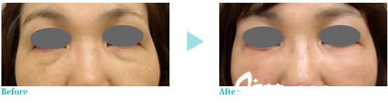 高濃度PRP治療法：去除松弛皺紋