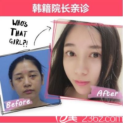 廣州紫馨曹仁昌做的雙眼皮修復(fù)案例 廣州紫馨曹仁昌做的雙眼皮修復(fù)案例