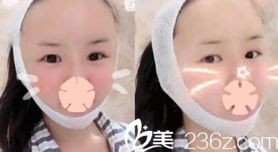 昆明美伊萊醫(yī)療美容自體脂肪面部填充天照