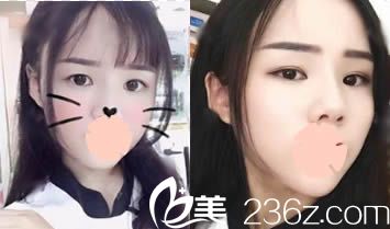 昆明美伊萊整形面部脂肪填充術(shù)后7天照