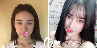 眼綜合+鼻綜合術(shù)后效果 眼綜合+鼻綜合術(shù)后效果