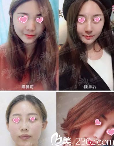 次選錯醫(yī)院后假體隆鼻失敗了，后來去贛州華美找王春做了鼻修復(fù)手術(shù)