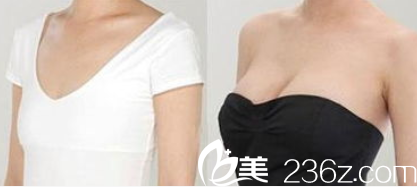 北京麥西美嘉徐永成醫(yī)生假體隆胸案例