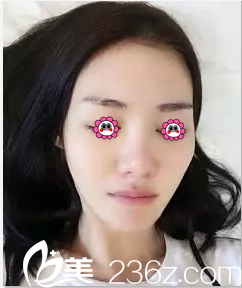 在北京麥西美嘉做隆鼻前樣子 在北京麥西美嘉做隆鼻前樣子