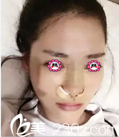 在北京麥西美嘉做硅膠假體隆鼻第3天效果 在北京麥西美嘉做硅膠假體隆鼻第3天效果