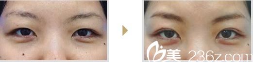 部分切開(kāi)法